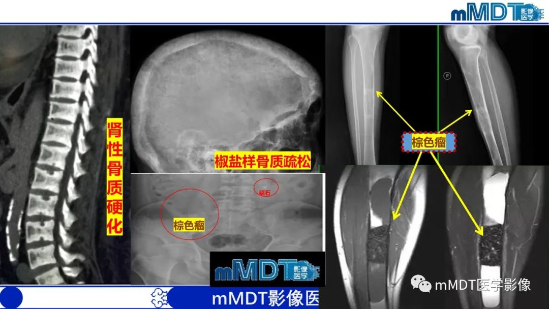 影像PPT - 【PPT】四肢短骨末端“消失”迷影追踪-30 影像PPT - 【PPT】四肢短骨末端“消失”迷影追踪-30