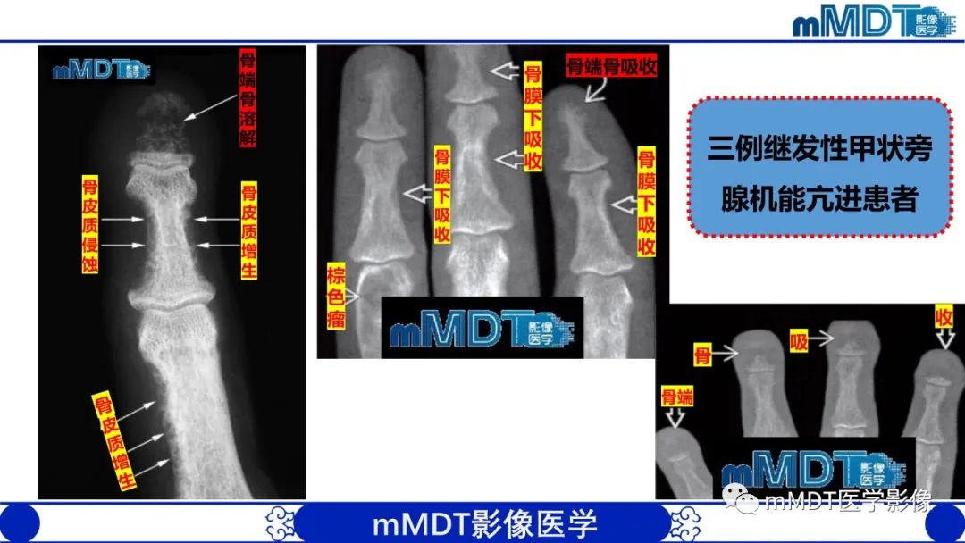 影像PPT - 【PPT】四肢短骨末端“消失”迷影追踪-31 影像PPT - 【PPT】四肢短骨末端“消失”迷影追踪-31