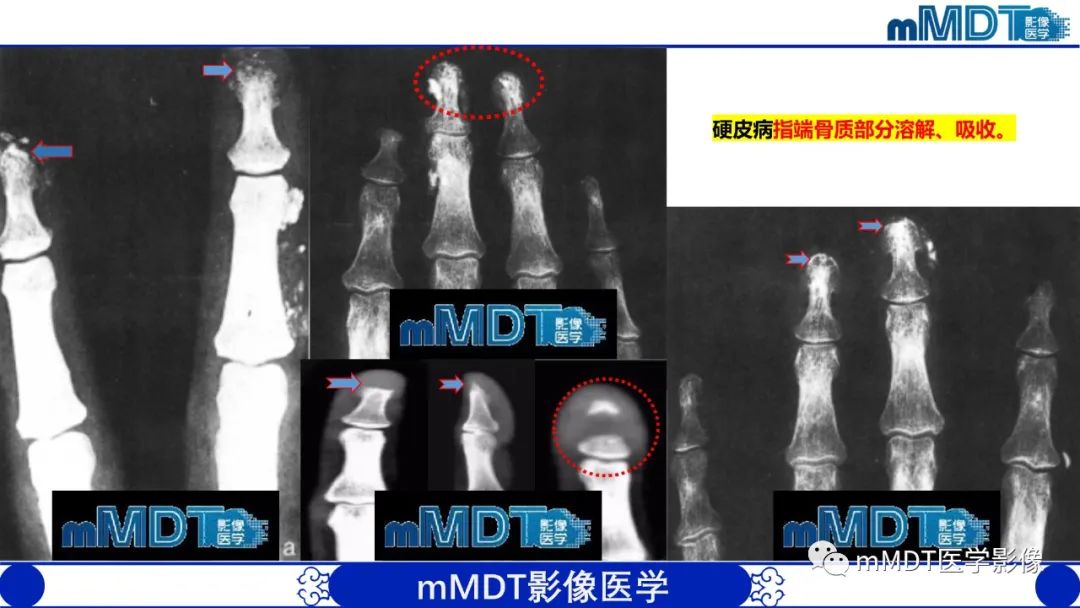 影像PPT - 【PPT】四肢短骨末端“消失”迷影追踪-34 影像PPT - 【PPT】四肢短骨末端“消失”迷影追踪-34