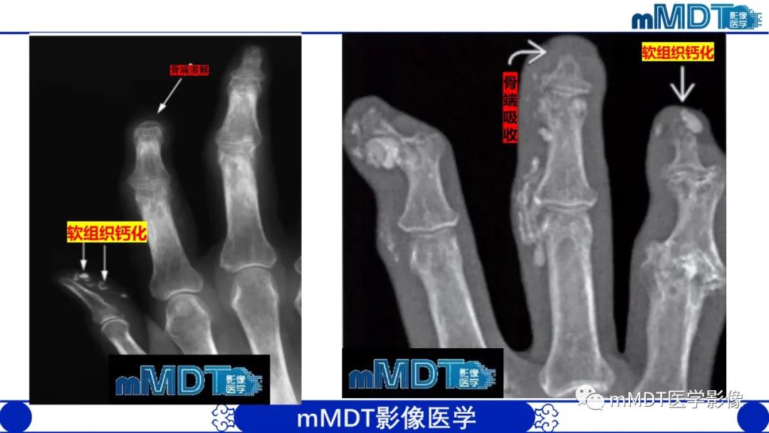 影像PPT - 【PPT】四肢短骨末端“消失”迷影追踪-35 影像PPT - 【PPT】四肢短骨末端“消失”迷影追踪-35