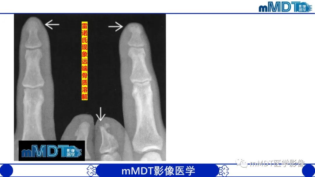影像PPT - 【PPT】四肢短骨末端“消失”迷影追踪-36 影像PPT - 【PPT】四肢短骨末端“消失”迷影追踪-36