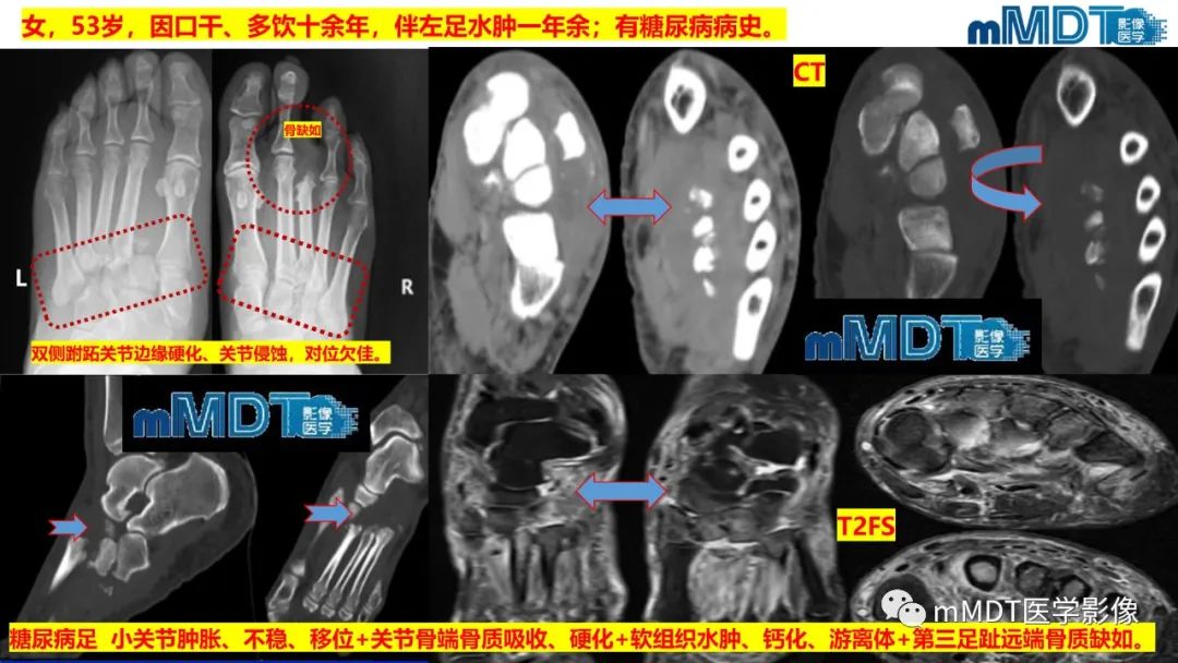 影像PPT - 【PPT】四肢短骨末端“消失”迷影追踪-40 影像PPT - 【PPT】四肢短骨末端“消失”迷影追踪-40