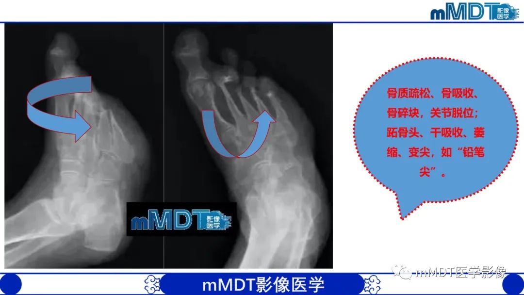 影像PPT - 【PPT】四肢短骨末端“消失”迷影追踪-41 影像PPT - 【PPT】四肢短骨末端“消失”迷影追踪-41
