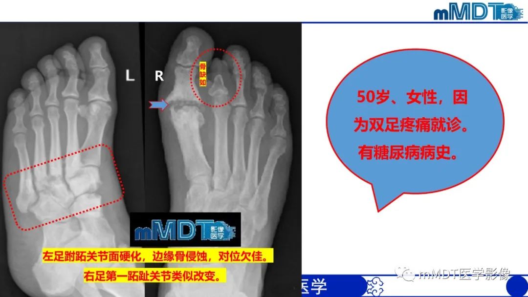 影像PPT - 【PPT】四肢短骨末端“消失”迷影追踪-39 影像PPT - 【PPT】四肢短骨末端“消失”迷影追踪-39