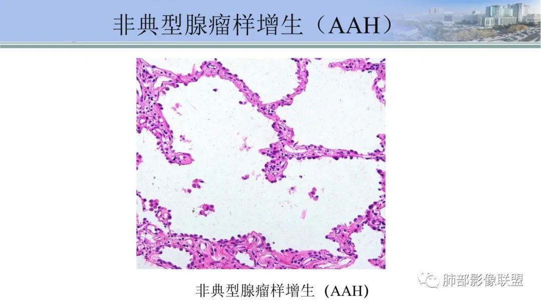 影像PPT - 【PPT】肺腺癌的病理诊断及鉴别诊断要点思考-6