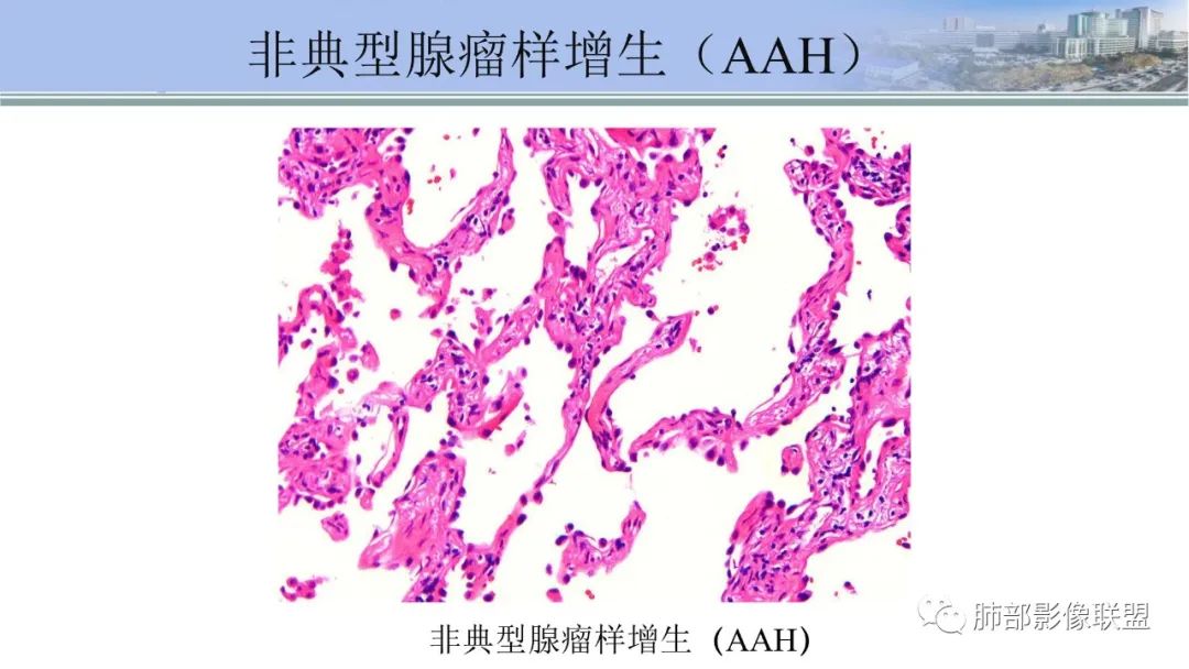 影像PPT - 【PPT】肺腺癌的病理诊断及鉴别诊断要点思考-7