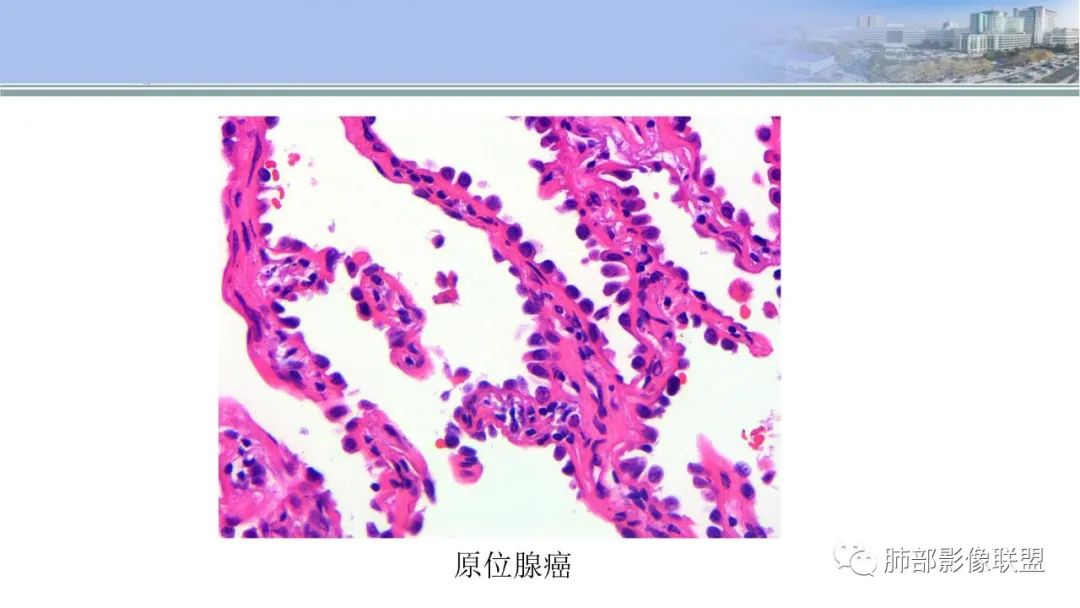 影像PPT - 【PPT】肺腺癌的病理诊断及鉴别诊断要点思考-10