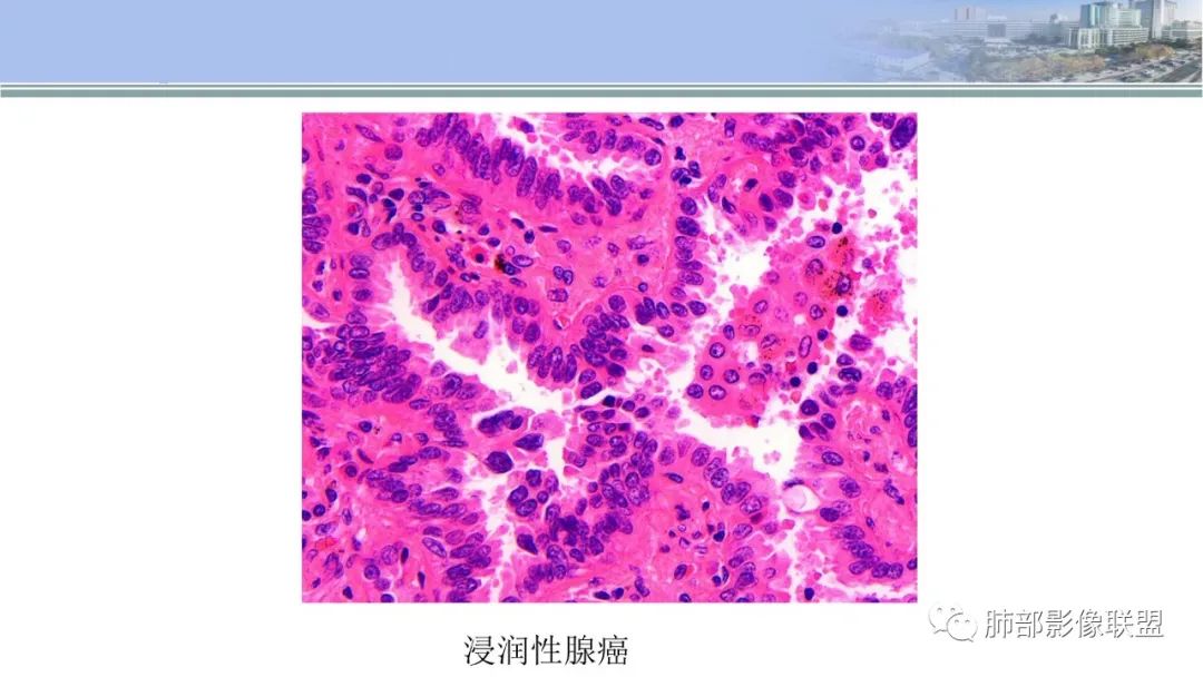 影像PPT - 【PPT】肺腺癌的病理诊断及鉴别诊断要点思考-14