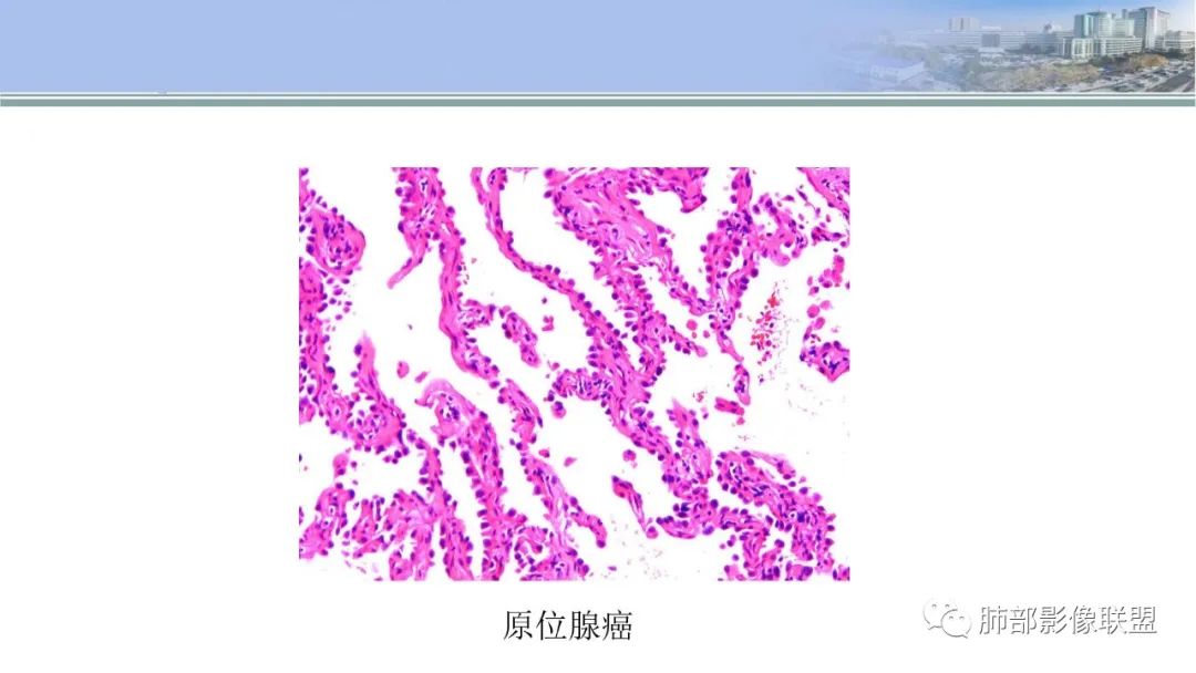 影像PPT - 【PPT】肺腺癌的病理诊断及鉴别诊断要点思考-11