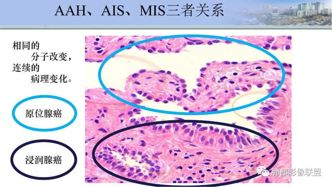 影像PPT - 【PPT】肺腺癌的病理诊断及鉴别诊断要点思考-19