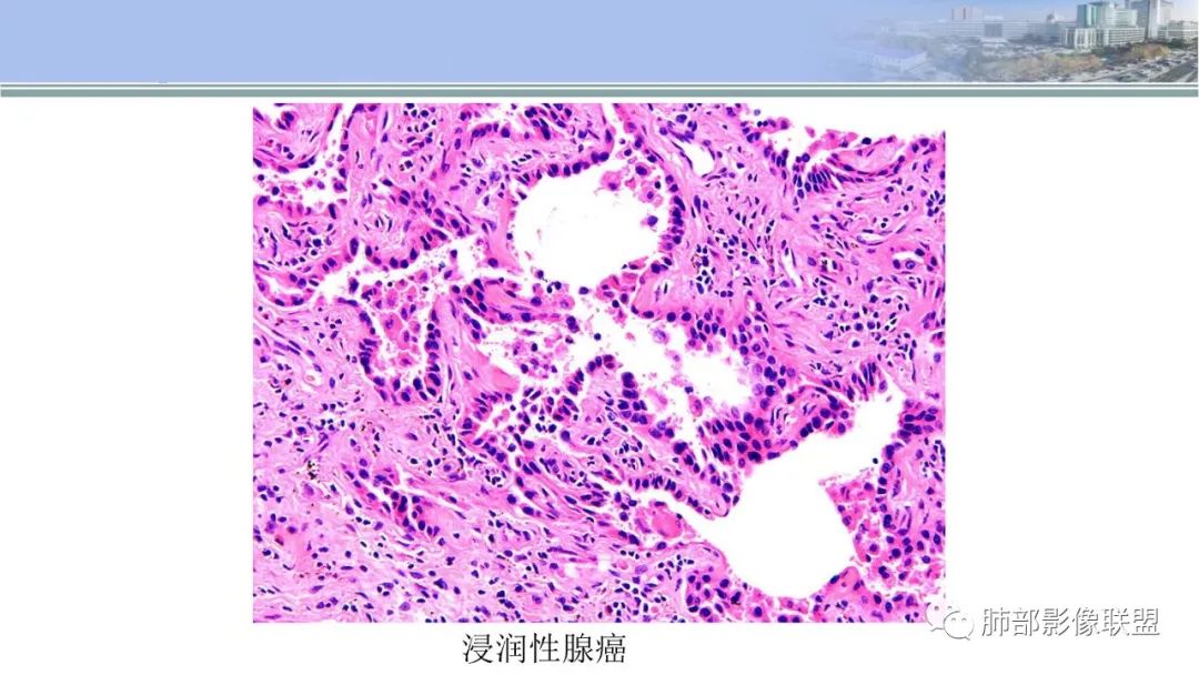 影像PPT - 【PPT】肺腺癌的病理诊断及鉴别诊断要点思考-15