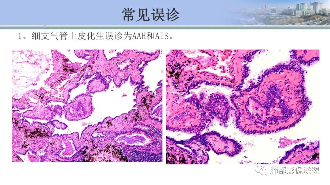 影像PPT - 【PPT】肺腺癌的病理诊断及鉴别诊断要点思考-22