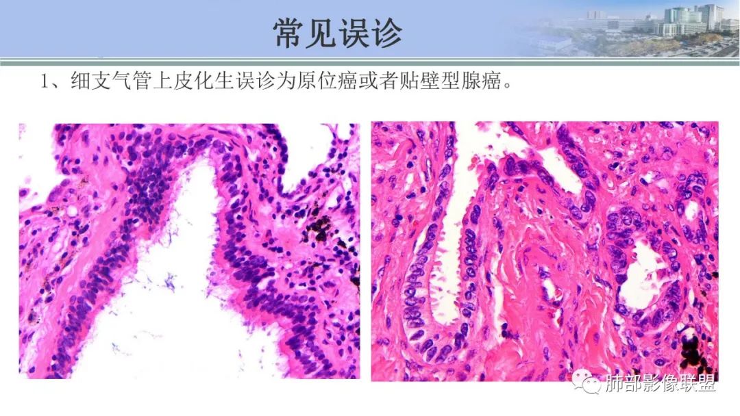 影像PPT - 【PPT】肺腺癌的病理诊断及鉴别诊断要点思考-23