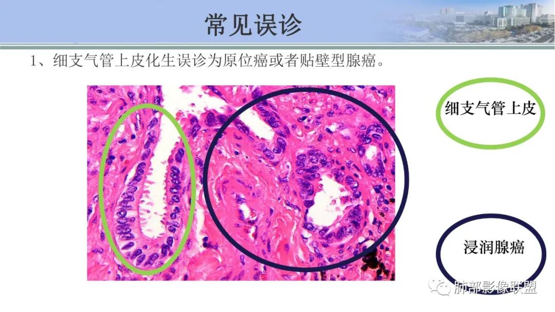 影像PPT - 【PPT】肺腺癌的病理诊断及鉴别诊断要点思考-24