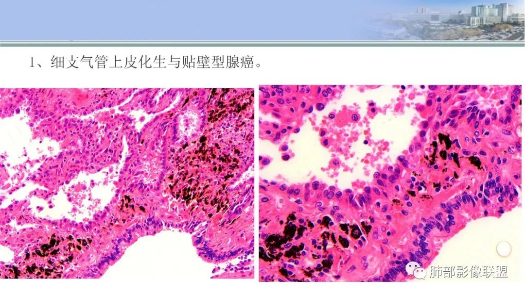 影像PPT - 【PPT】肺腺癌的病理诊断及鉴别诊断要点思考-26
