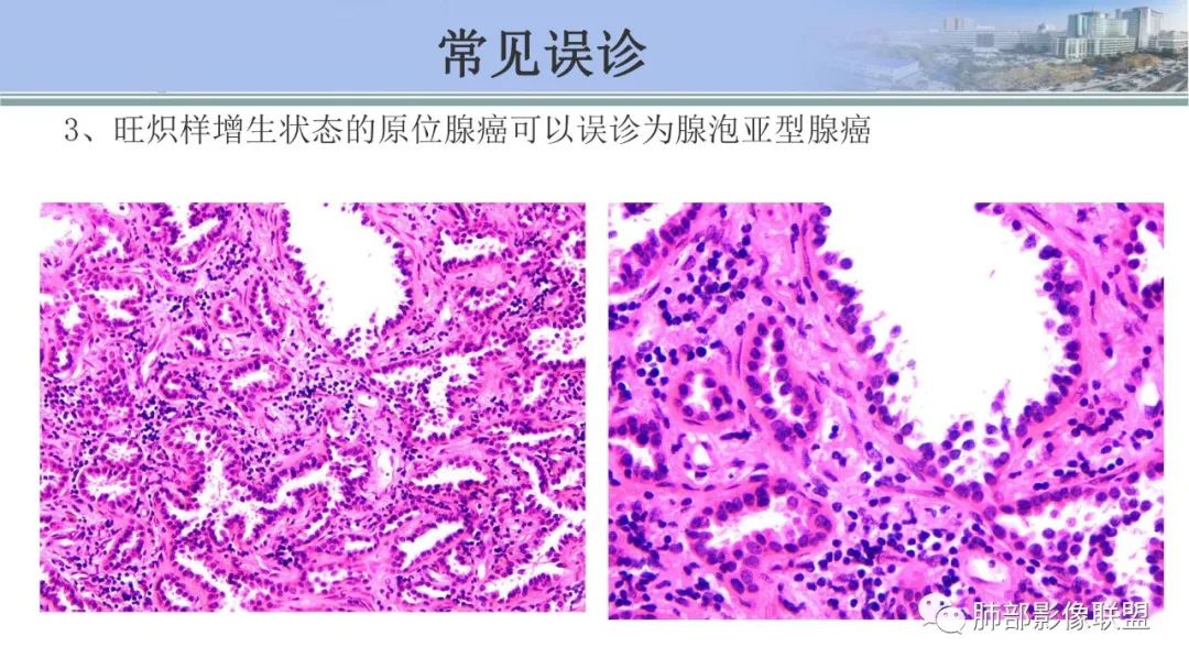影像PPT - 【PPT】肺腺癌的病理诊断及鉴别诊断要点思考-28