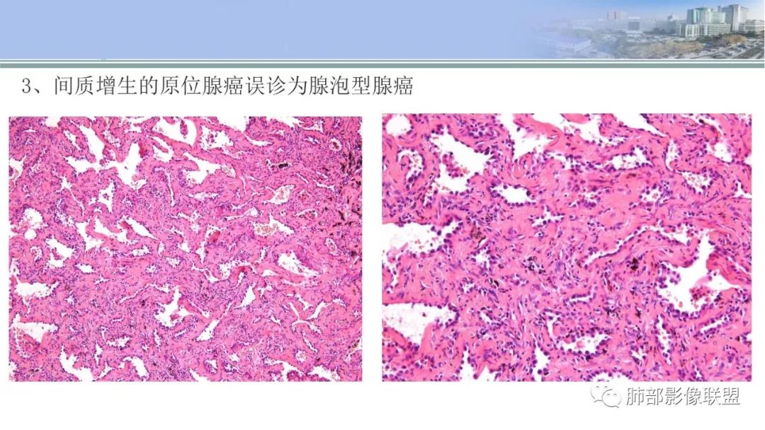 影像PPT - 【PPT】肺腺癌的病理诊断及鉴别诊断要点思考-30
