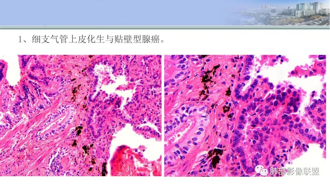 影像PPT - 【PPT】肺腺癌的病理诊断及鉴别诊断要点思考-25