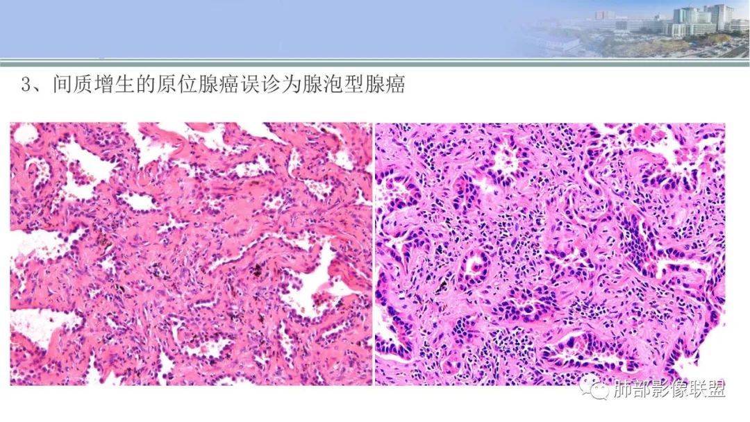 影像PPT - 【PPT】肺腺癌的病理诊断及鉴别诊断要点思考-32