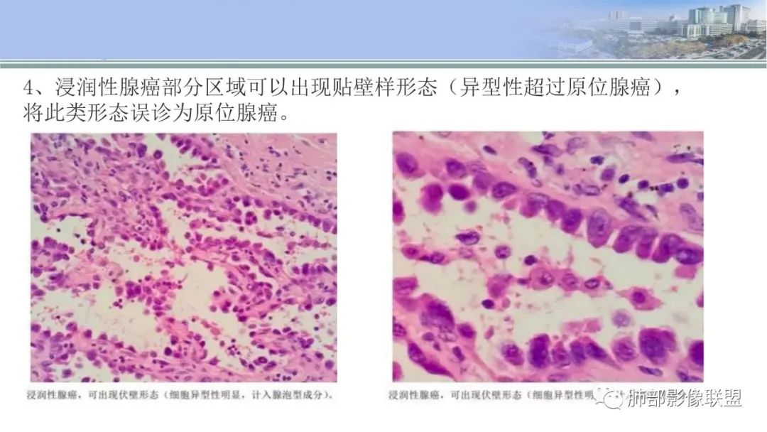 影像PPT - 【PPT】肺腺癌的病理诊断及鉴别诊断要点思考-33