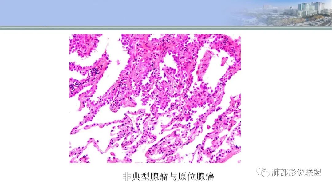 影像PPT - 【PPT】肺腺癌的病理诊断及鉴别诊断要点思考-34