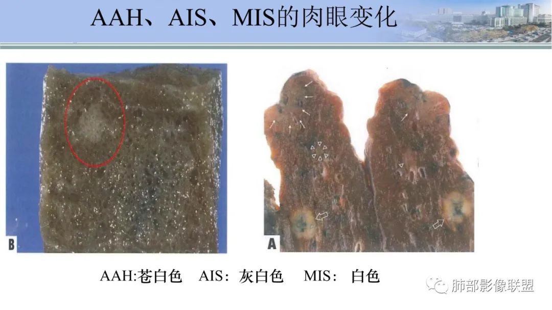 影像PPT - 【PPT】肺腺癌的病理诊断及鉴别诊断要点思考-18