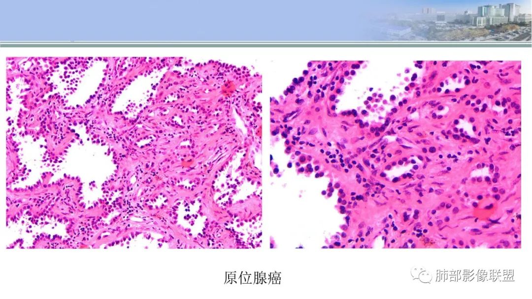 影像PPT - 【PPT】肺腺癌的病理诊断及鉴别诊断要点思考-36