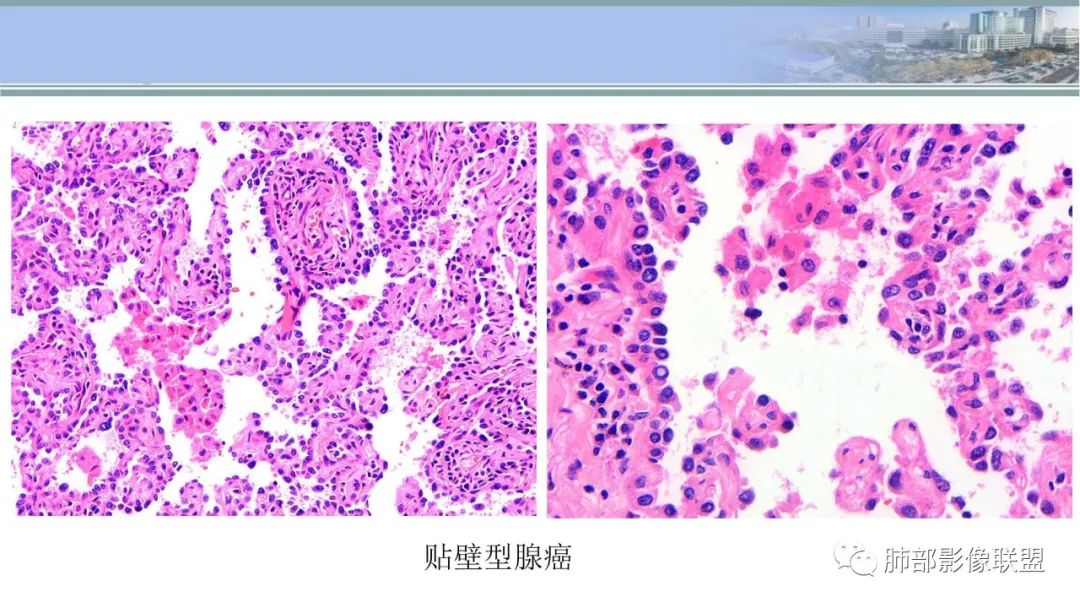 影像PPT - 【PPT】肺腺癌的病理诊断及鉴别诊断要点思考-43