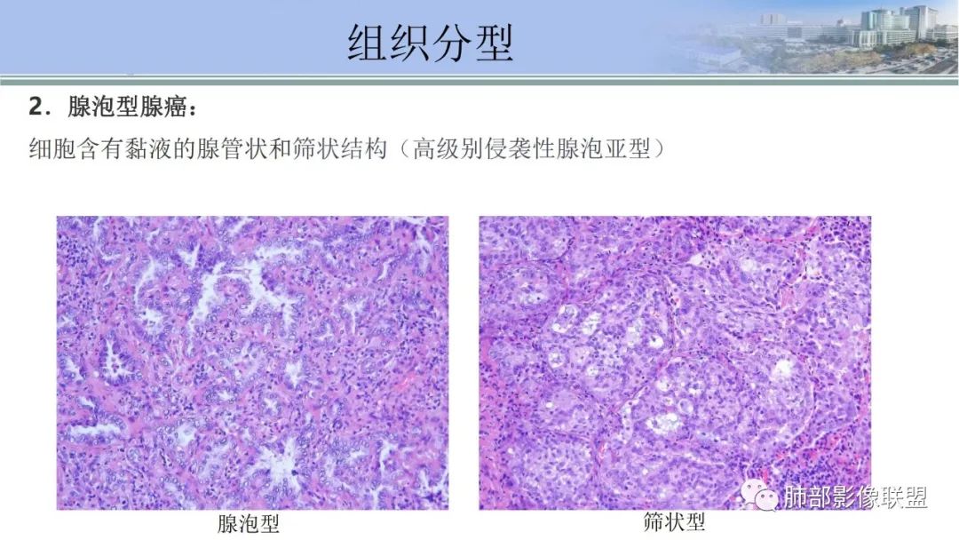 影像PPT - 【PPT】肺腺癌的病理诊断及鉴别诊断要点思考-44