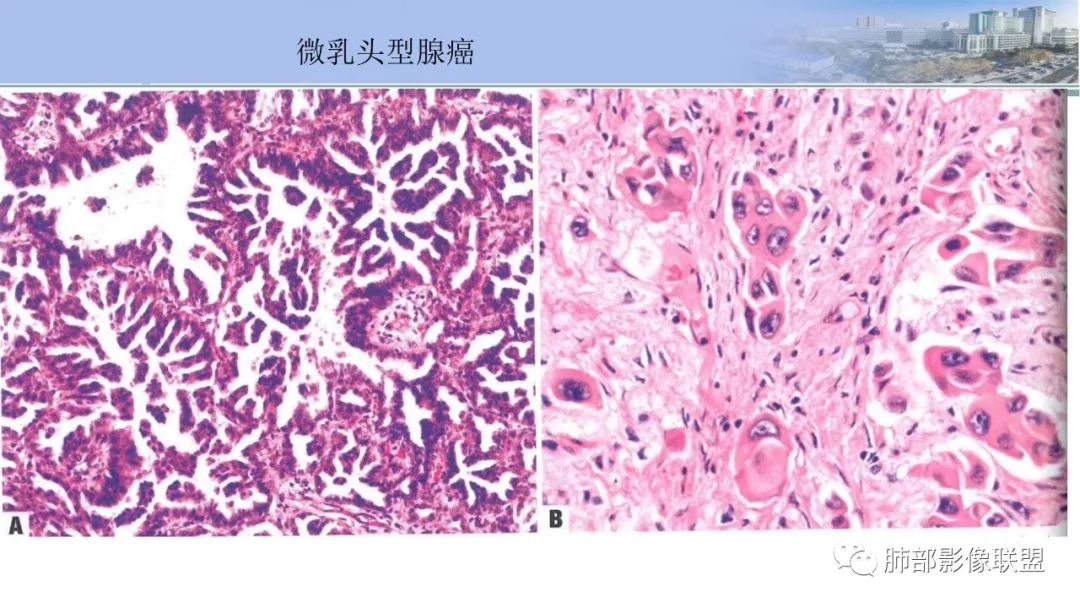 影像PPT - 【PPT】肺腺癌的病理诊断及鉴别诊断要点思考-48