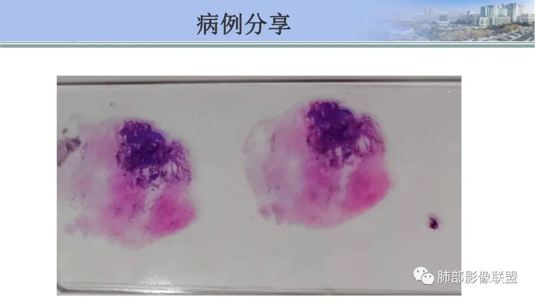 影像PPT - 【PPT】肺腺癌的病理诊断及鉴别诊断要点思考-56