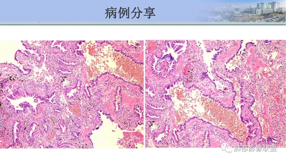 影像PPT - 【PPT】肺腺癌的病理诊断及鉴别诊断要点思考-58