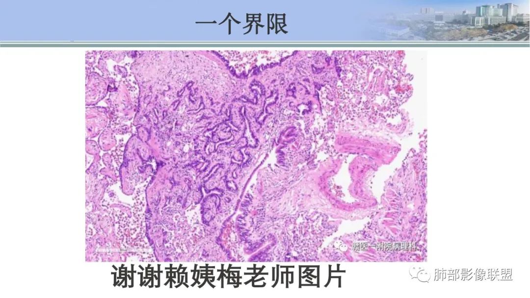 影像PPT - 【PPT】肺腺癌的病理诊断及鉴别诊断要点思考-62