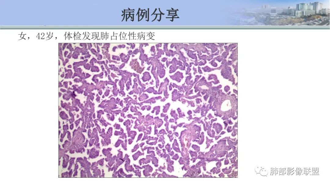 影像PPT - 【PPT】肺腺癌的病理诊断及鉴别诊断要点思考-67