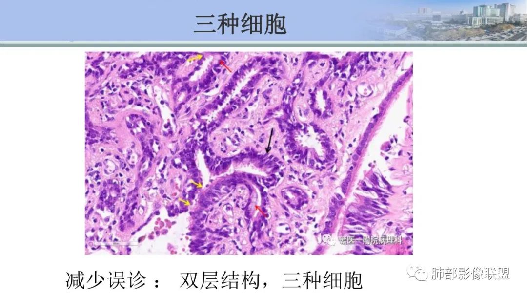 影像PPT - 【PPT】肺腺癌的病理诊断及鉴别诊断要点思考-64
