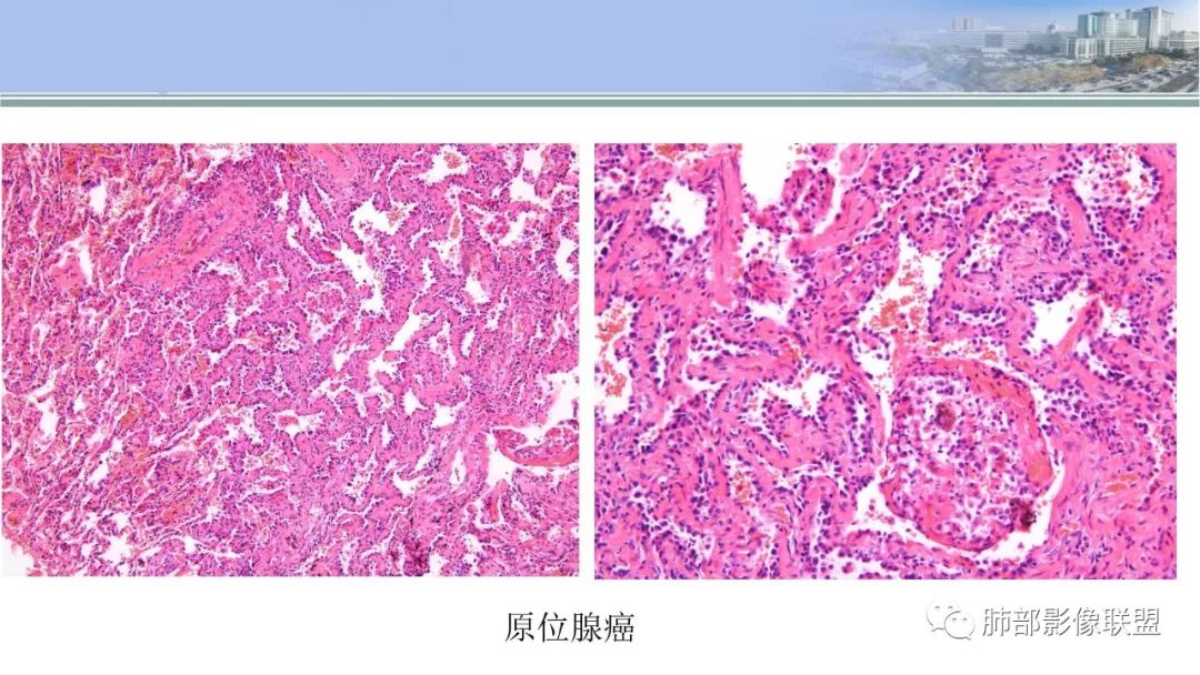 影像PPT - 【PPT】肺腺癌的病理诊断及鉴别诊断要点思考-35