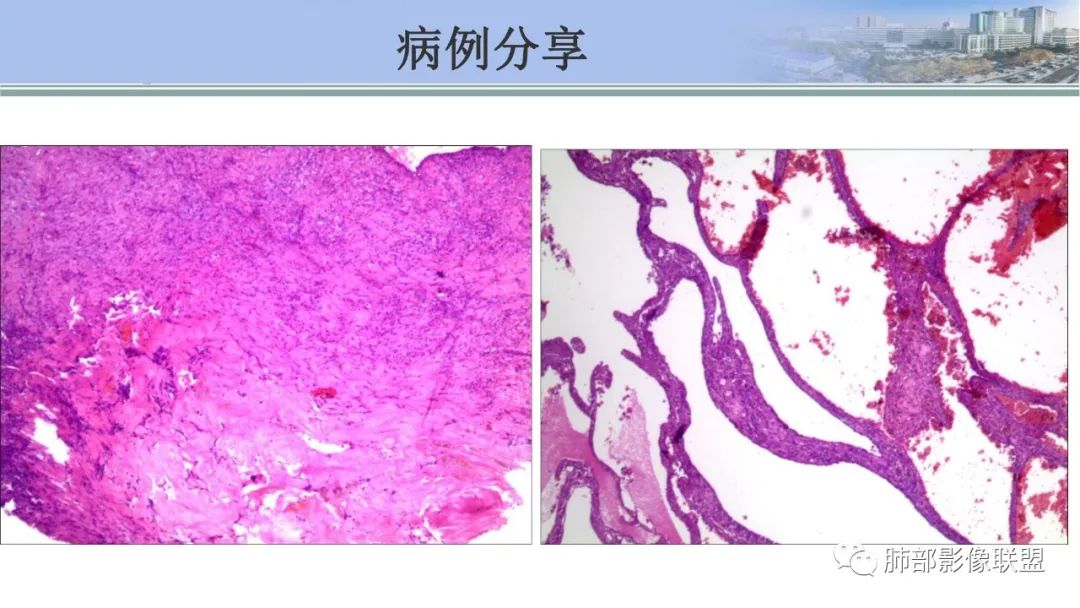 影像PPT - 【PPT】肺腺癌的病理诊断及鉴别诊断要点思考-72