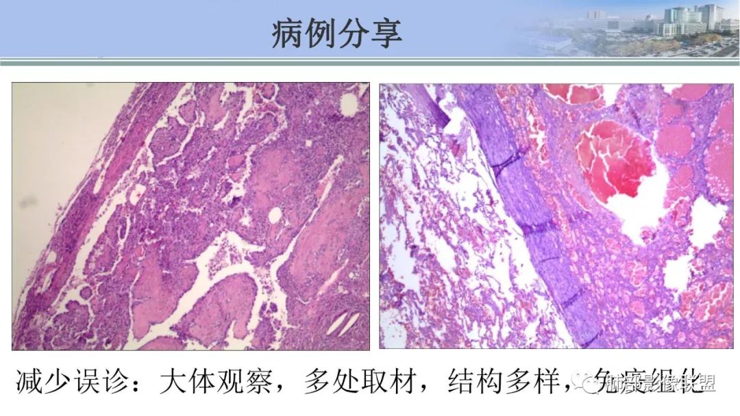 影像PPT - 【PPT】肺腺癌的病理诊断及鉴别诊断要点思考-76