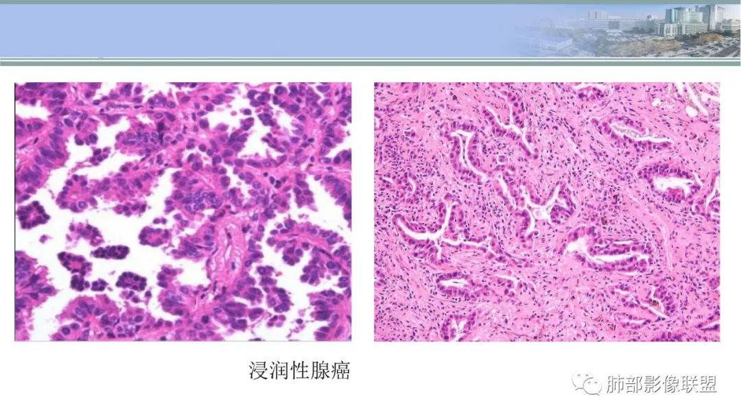 影像PPT - 【PPT】肺腺癌的病理诊断及鉴别诊断要点思考-38