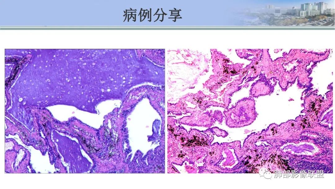 影像PPT - 【PPT】肺腺癌的病理诊断及鉴别诊断要点思考-57
