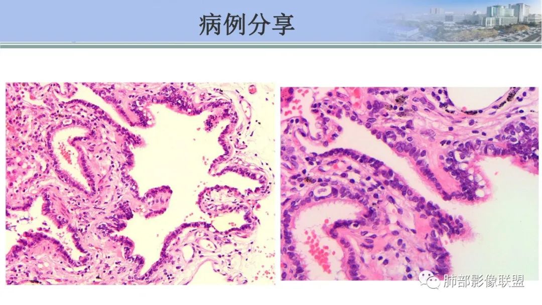 影像PPT - 【PPT】肺腺癌的病理诊断及鉴别诊断要点思考-59