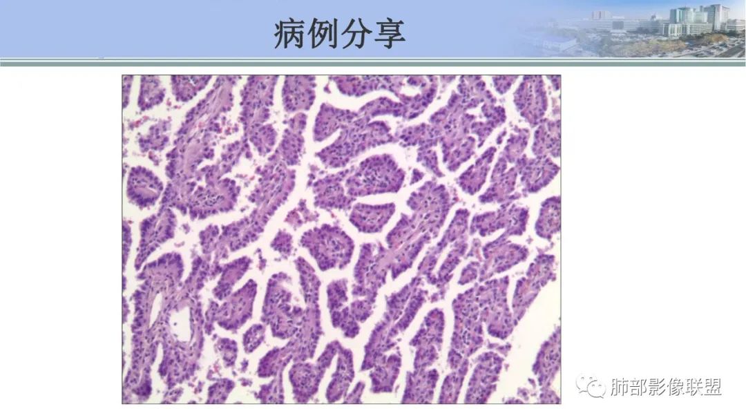 影像PPT - 【PPT】肺腺癌的病理诊断及鉴别诊断要点思考-68