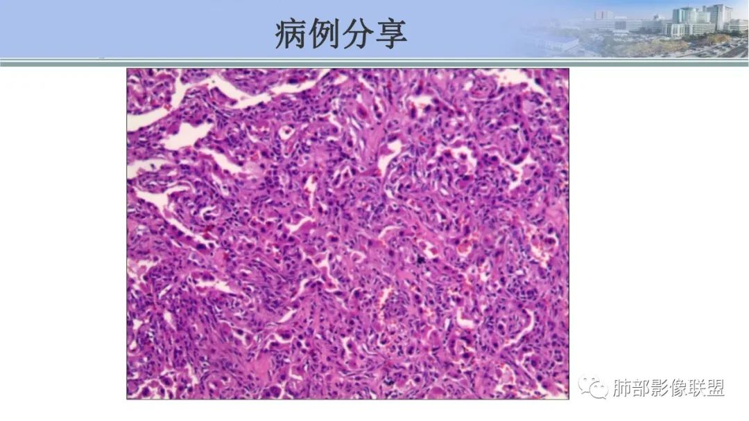 影像PPT - 【PPT】肺腺癌的病理诊断及鉴别诊断要点思考-69