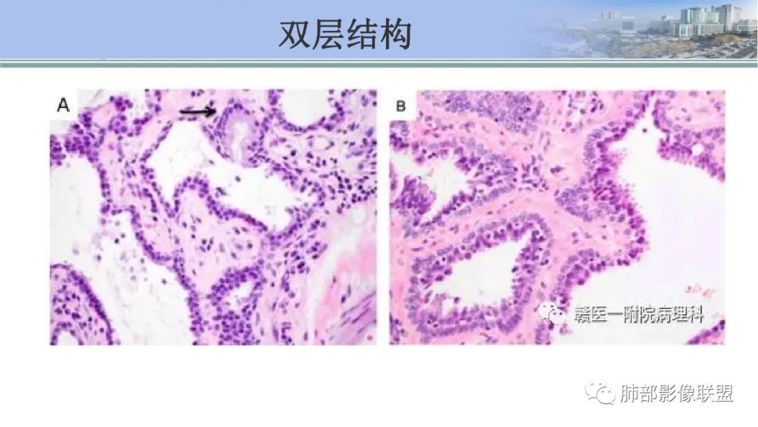 影像PPT - 【PPT】肺腺癌的病理诊断及鉴别诊断要点思考-63