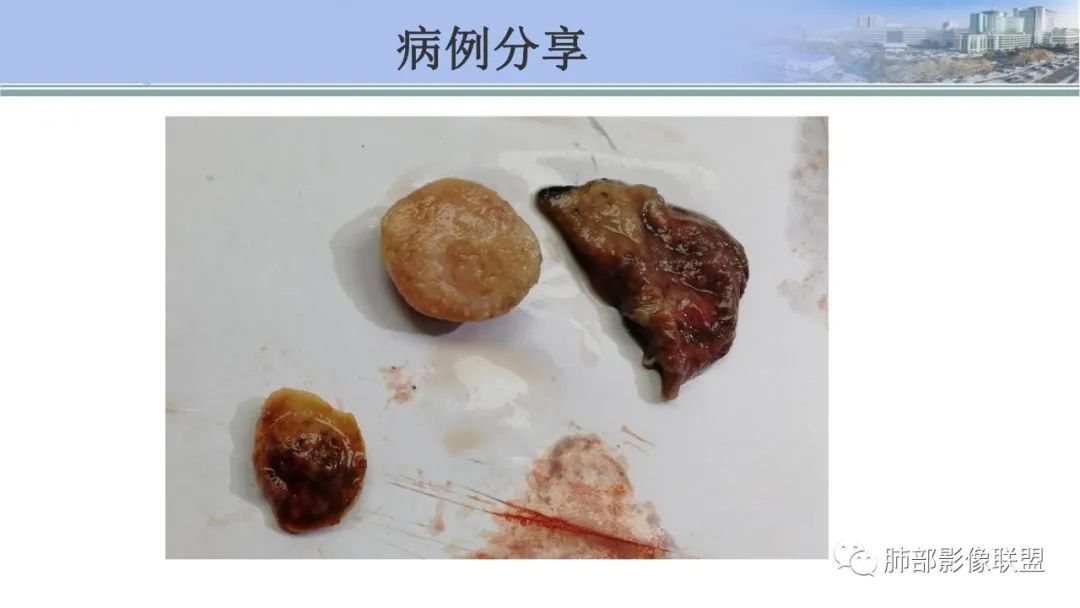 影像PPT - 【PPT】肺腺癌的病理诊断及鉴别诊断要点思考-71