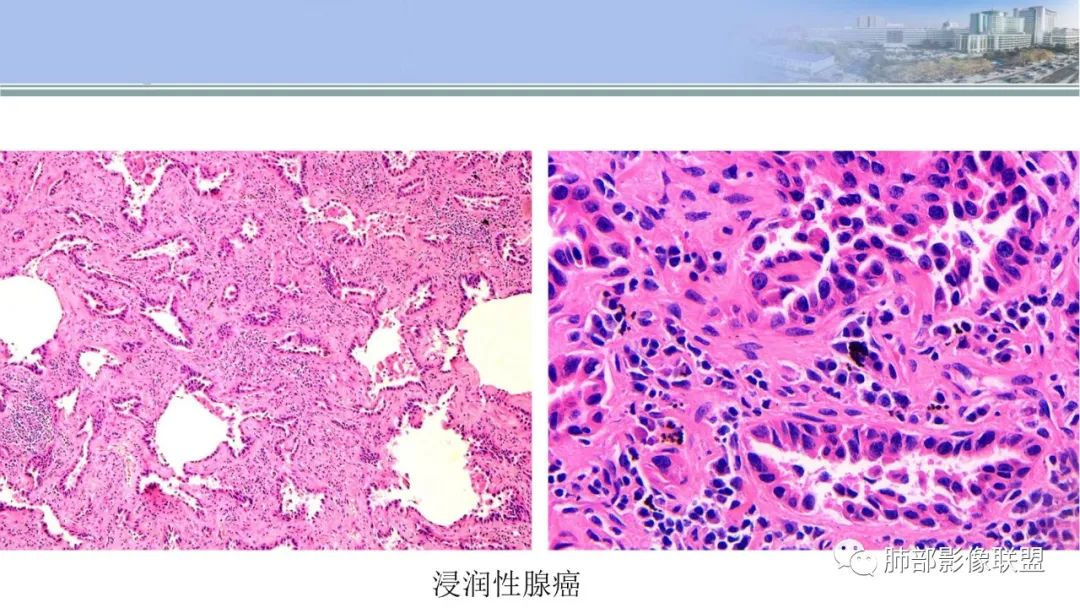 影像PPT - 【PPT】肺腺癌的病理诊断及鉴别诊断要点思考-37