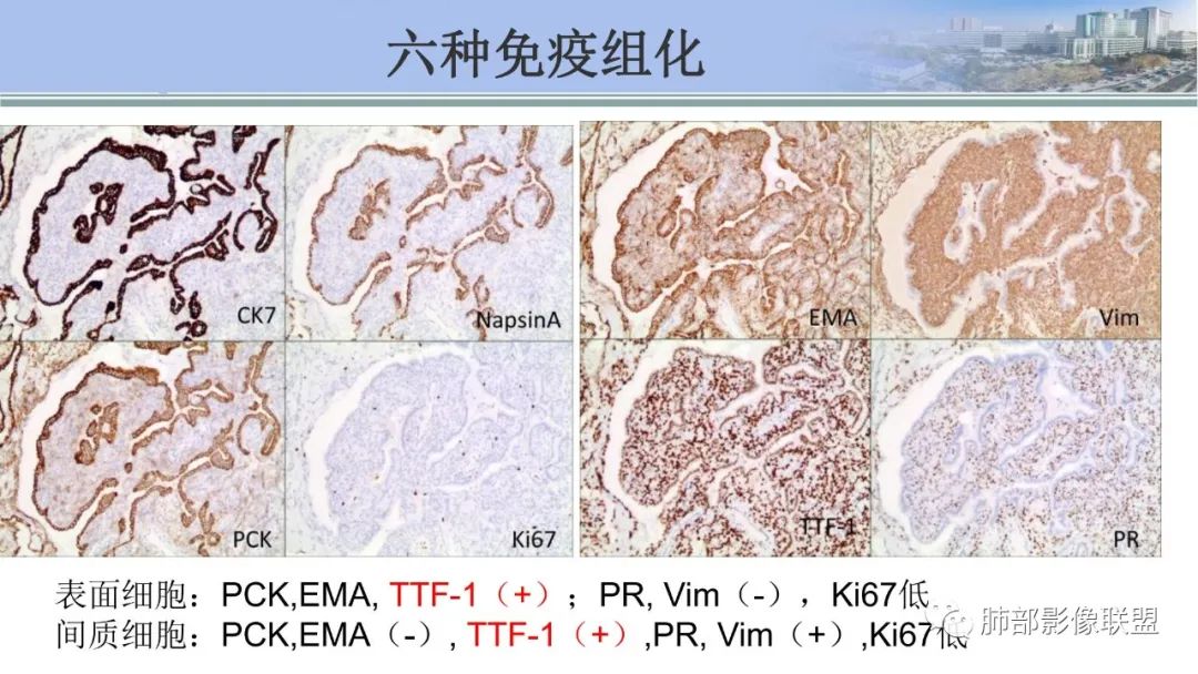 影像PPT - 【PPT】肺腺癌的病理诊断及鉴别诊断要点思考-75