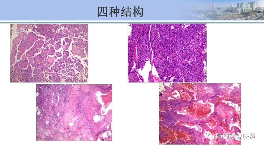 影像PPT - 【PPT】肺腺癌的病理诊断及鉴别诊断要点思考-74