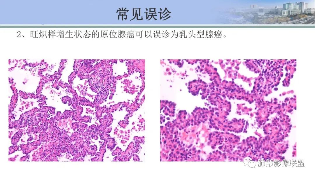 影像PPT - 【PPT】肺腺癌的病理诊断及鉴别诊断要点思考-1