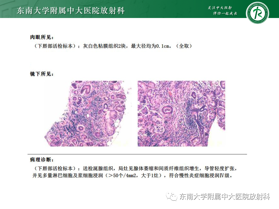 影像PPT - 【PPT】原发性干燥综合征的肺部改变-5 影像PPT - 【PPT】原发性干燥综合征的肺部改变-5